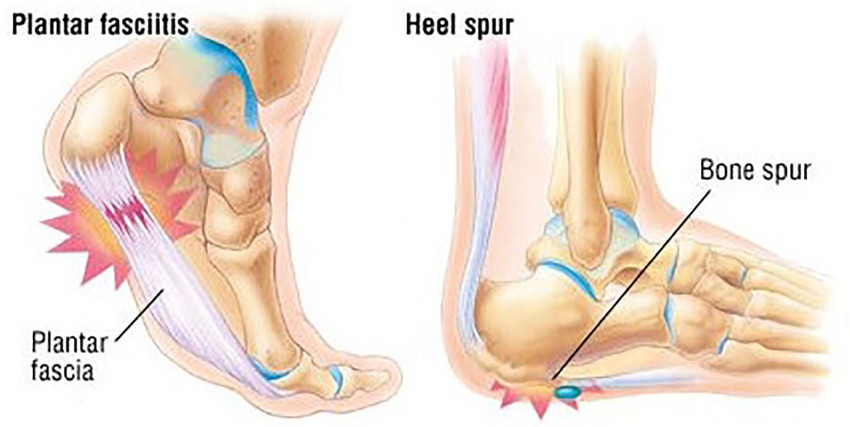 Calcaneus Causes Of Extreme Heel Pain Anatomy Sharp Pain Inside